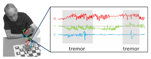 Preview_2020_Sensors_PDTremorDetection.jpg